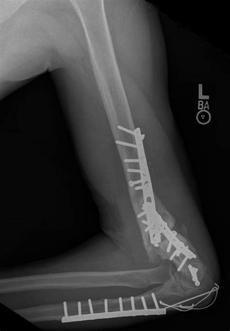 Infected Nonunion: Elbow Case 1 - Dr. Mark Brinker, Houston Orthopedic