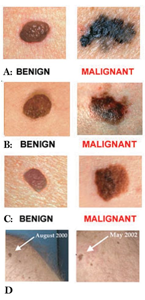 Learning Your Abcdes Of Melanoma