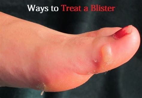 How To Treat A Foot Blister How To Treat Blisters Blister Remedies
