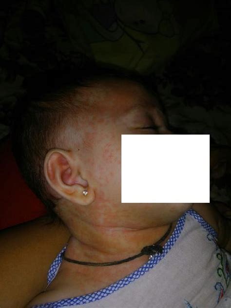 Diagnosis For Rashes In 6 Months Old Child