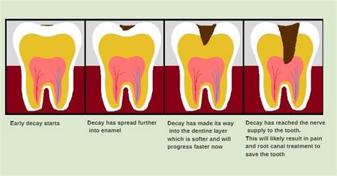 Progression Of Tooth Decay All Smiles Dent Spa
