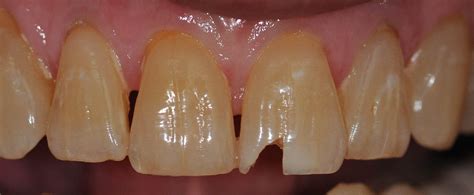 Updated on november 18, 2008. Before and After Dental Bonding & Emergency Dental Care Photos