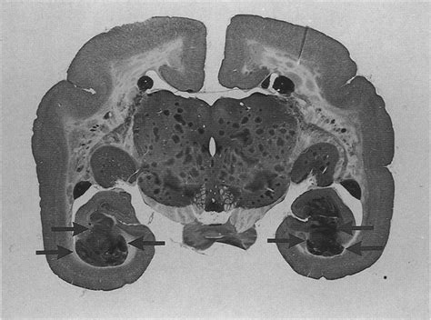 Coronal Section Of A Marmoset Brain Stained For Ache Showing