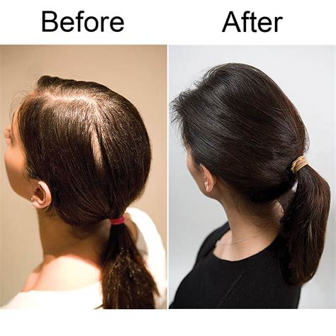 At the end of the study there were visible improvements in two subjects. Viviscal Hair Nutrient Tablet - Hair Vitamin - Miles Kimball