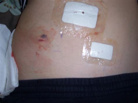 What Caused These Post Operative Complications In A Tep Inguinal Hernia