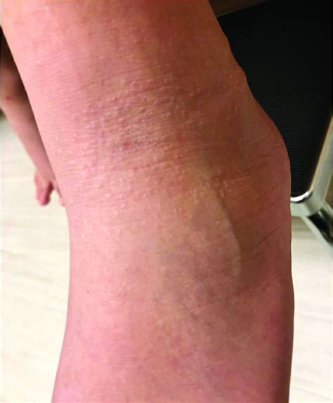 Rash On Hands And Feet Mdedge Dermatology