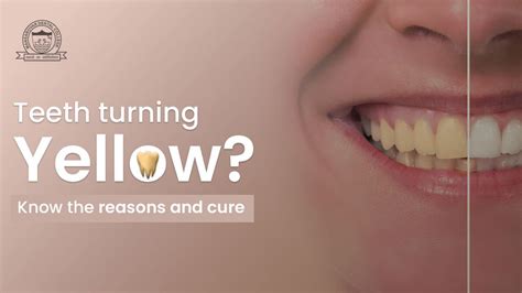 Teeth Turning Yellow Know The Reasons And Cure