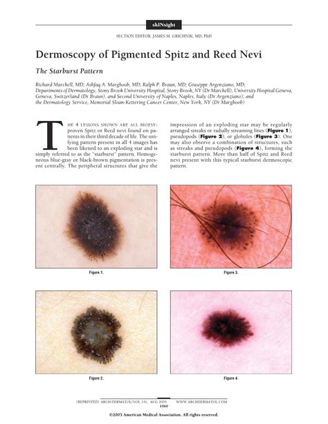 Dermoscopy Of Pigmented Spitz And Reed Nevi Dermatology Jama