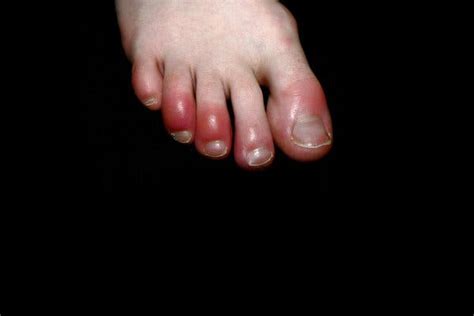 What Is ‘covid Toe Maybe A Strange Sign Of Coronavirus Infection