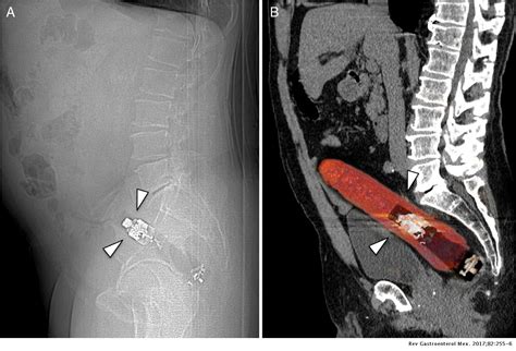 Rectal Foreign Body Revista De Gastroenterología De México