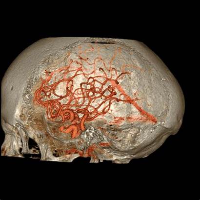 Ct Cerebrovascular Angiography Artery Cerebral Middle Min