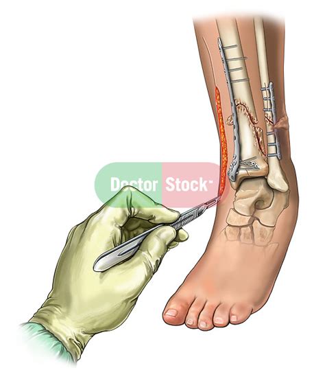 Malunion Of Tibial Fracture Fixation Doctor Stock