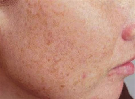 Liver Spots Causes Treatments And Removal Options Youmemindbody