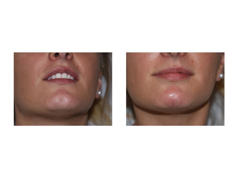 Cleft Chin Removal Before And After