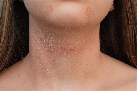 Eczema Cyprus Dermatology Clinic