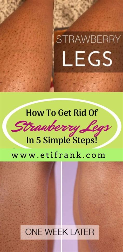 How to get rid of Strawberry Legs Naturally in 2020 ...