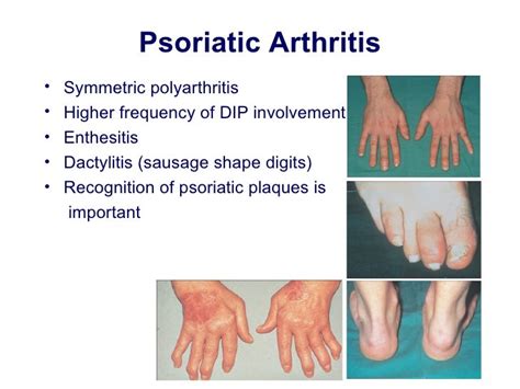 Approach To A Patient With Polyarthritis