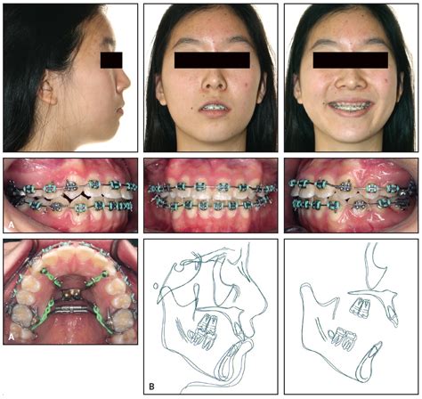 Effective Vertical Control Of The Entire Maxillary Arch With A Palatal Tad Supported Appliance
