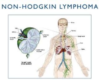 Sistem limfatik merupakan bagian dari imunitas tubuh. Limfoma Non-Hodgkin | atelieelissilva