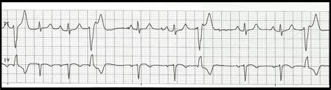 Ekg Rhythm Strip Quiz 124