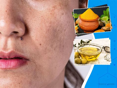 8 Home Remedies To Treat Skin Pigmentation Onlymyhealth