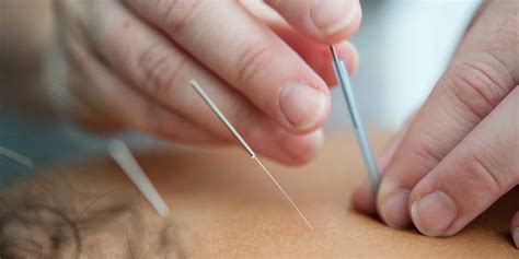 Top Benefits Of Acupuncture Chinook Rehab Centre