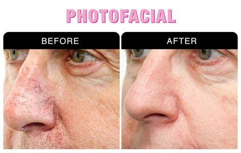 Photofacial Skin Rejuvenation At National Laser Institute
