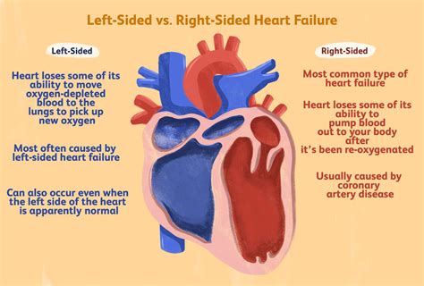 Right Vs Left Sided Heart Failure Chart My Xxx Hot Girl