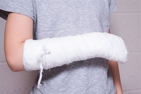 Everything You Need To Know About Arm Casts
