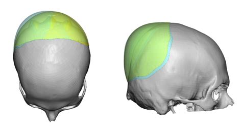 Plastic Surgery Case Study The Over Corrected Custom Occipital Skull