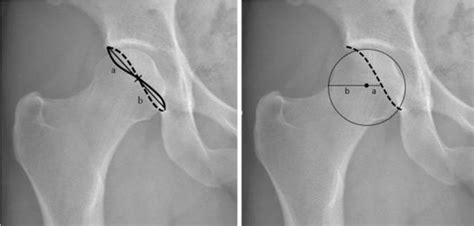 Figure 2 From Radiographic Signs Of Acetabular Retroversion Using A Low