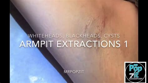 Armpit Extractions 1 Blackheads Whiteheads Milia Small Cyst Pops