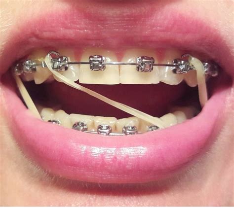 Pin By Jamie Richie On Braces And Retainers Orthodontics Braces Girls