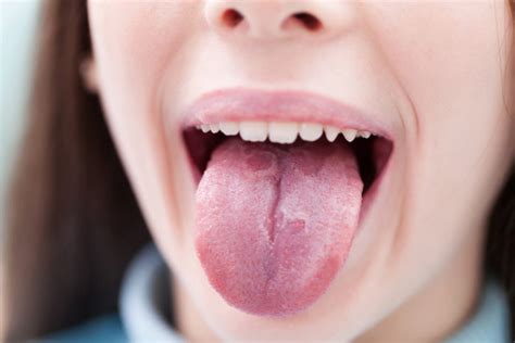 Mengenali Gejala Faktor Risiko Dan Perawatan Psoriasis Pada Mulut