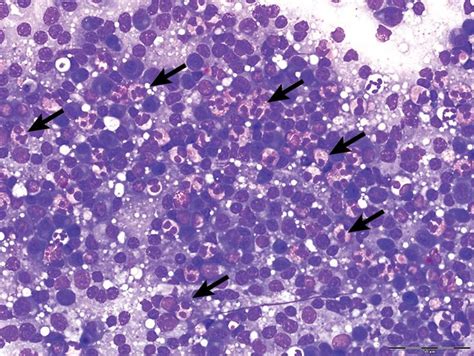 Top 5 Cytologic Findings In Aspirates Of Enlarged Lymph Nodes
