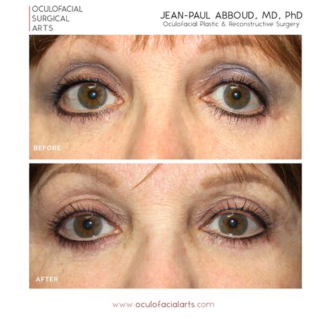 Cosmetic Eyelid Surgery Revision Why You Should Trust Your Eyelids To