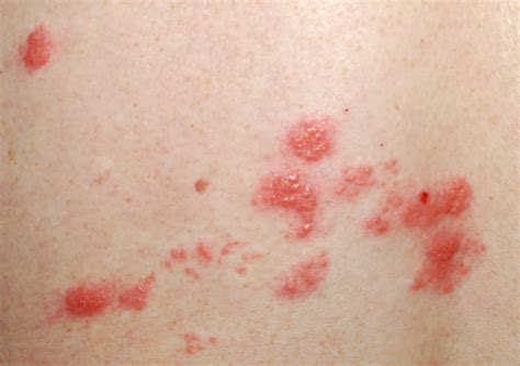 Red Itchy Bumps On Skin Causes Symptoms Pictures Treatment