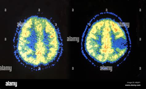 Pet Scans Of Normal And Abnormal Brains Stock Photo Alamy