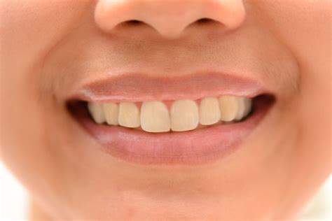 Как получить идеальные зубы 11 шагов