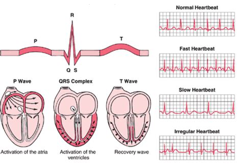 To make a definitive diagnosis, a doctor needs more information than the. Different Heart Rhythms | HubPages