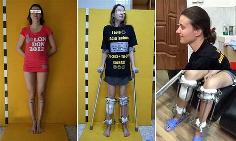Aspiring Model Told She Was Too Short Has Her Legs Surgically