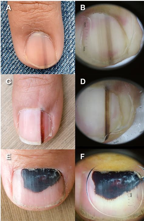 Fingernails Ingrown Fingernails Dark Line Fingernail Pain