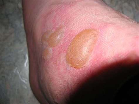 Blisters From Allergic Reaction Dhugal Fletcher Flickr