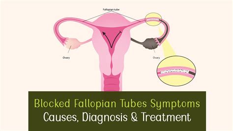 Blocked Fallopian Tubes Symptoms Causes And Treatment Evaivf