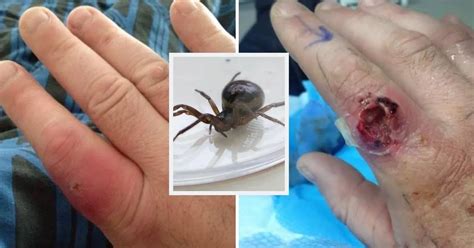 False Widow Spider Bite Nearly Cost Joiner His Finger As He Watched Netflix Chronicle Live