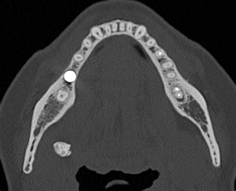 Sialolithiasis Radiology Case