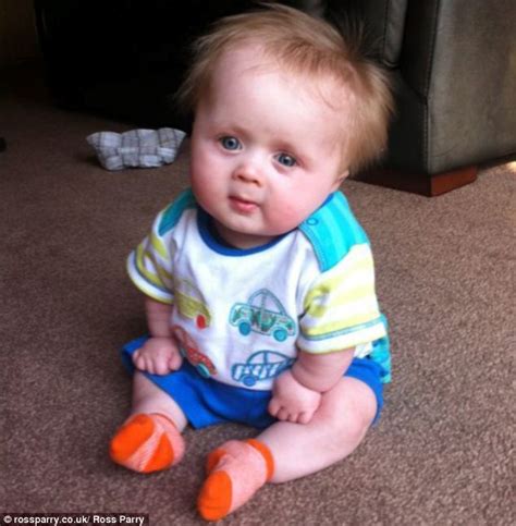 Boy 3 Is The Only Child In Uk With Brody Syndrome An Ultra Rare Form