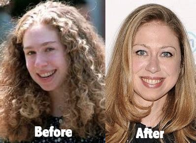 Chelsea Clinton Plastic Surgery Before and After Photos