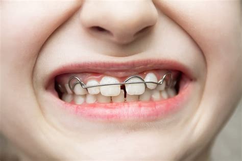 ¿qué Es La Ortodoncia Removible En Adultos Y Niños