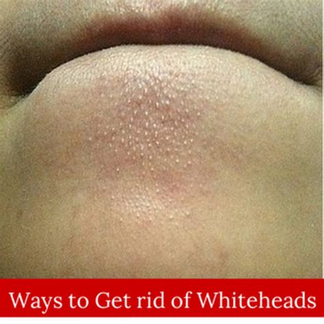 How To Get Rid Of Whiteheads Health And Beauty Tips Beauty Hacks